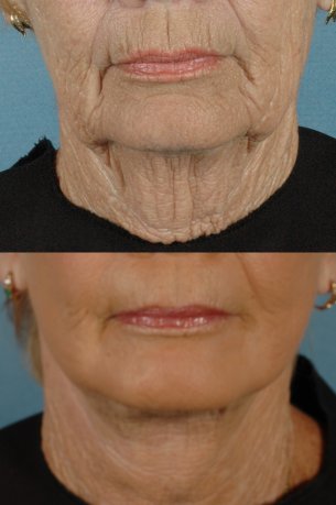 LOWER FACE | Facelift | Before and After Treatment Photos: Female (frontal view)