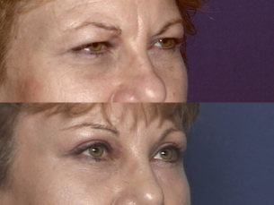 FOREHEAD AND BROWS: Before and After Treatment Photos: Female (right side, oblique view)