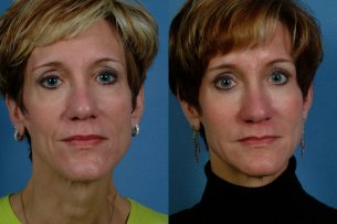 MIDDLE FACE | Before and After Treatment - Photos: Female (frontal view)