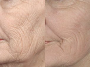 Perioral Laser Resurfacing - Before and After Photos: Female (oblique view)