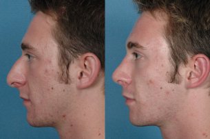 Before and After Photos: Nose - Male (left side view)