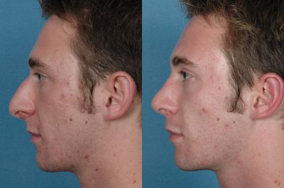 Gallery: Nose - Septorhinoplasty - Before and After Treatment Photos: Male (left side view)