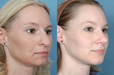 Gallery: Nose - Septorhinoplasty - Before and After Treatment Photos: Female (right side, oblique view)