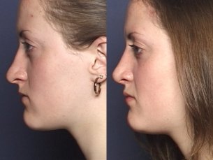 NOSE |Septorhinoplasty| Before and After treatment - Photo: Female patient (left side view)