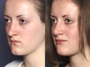 NOSE |Septorhinoplasty| Before and After treatment - Photo: Female patient (left side, oblique view)