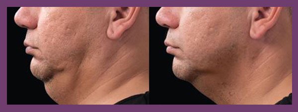 male patient before and after Coolsculpting for the Chin