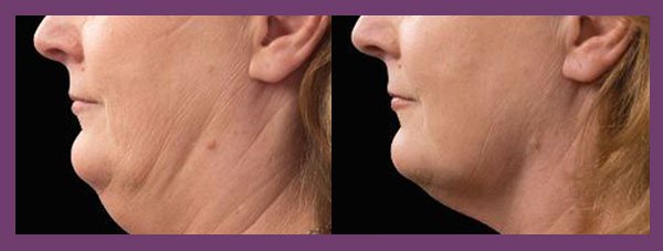 patient before and after Coolsculpting for the Chin
