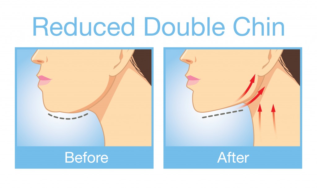 Reduced Double Chin Before and After