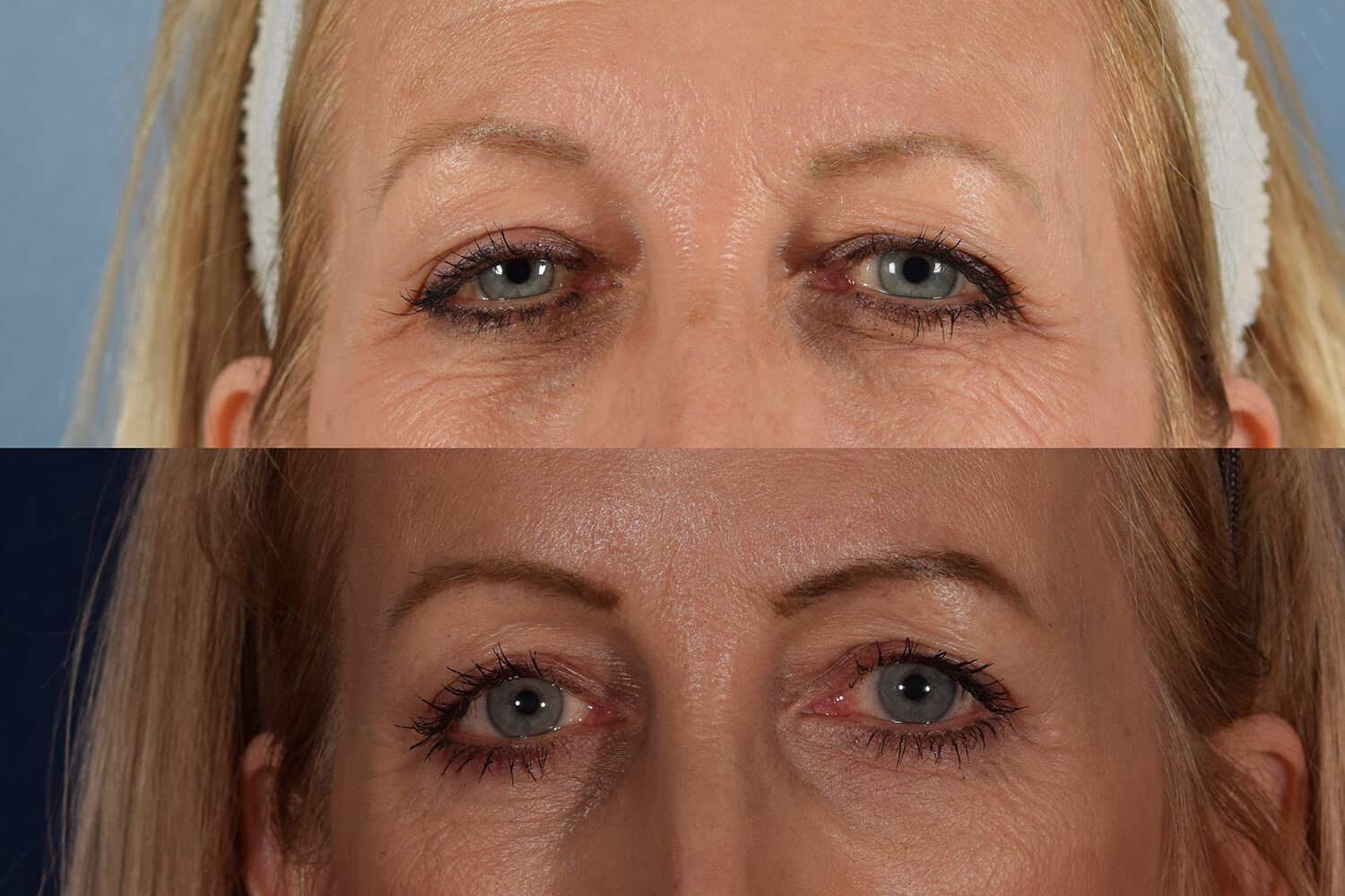 Gallery: Endoscopic Brow Lift and Upper Eyelid Surgery